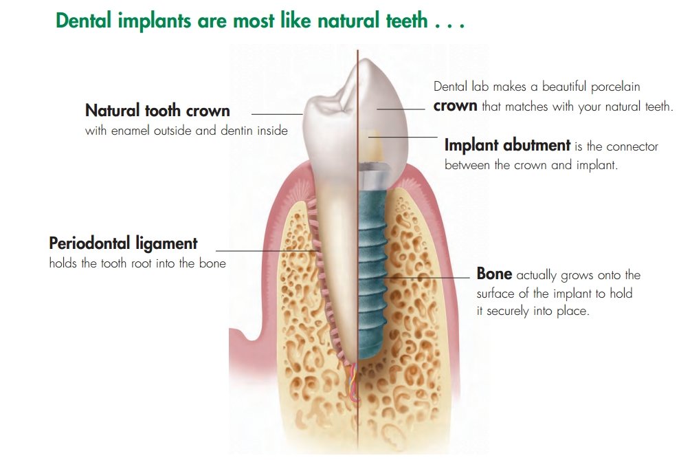 Dental Implants Glasgow