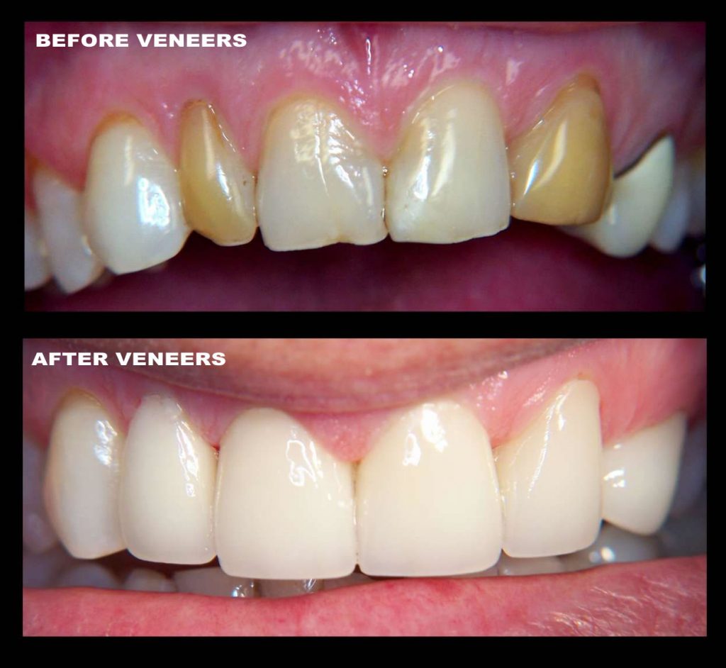 veneers manchester